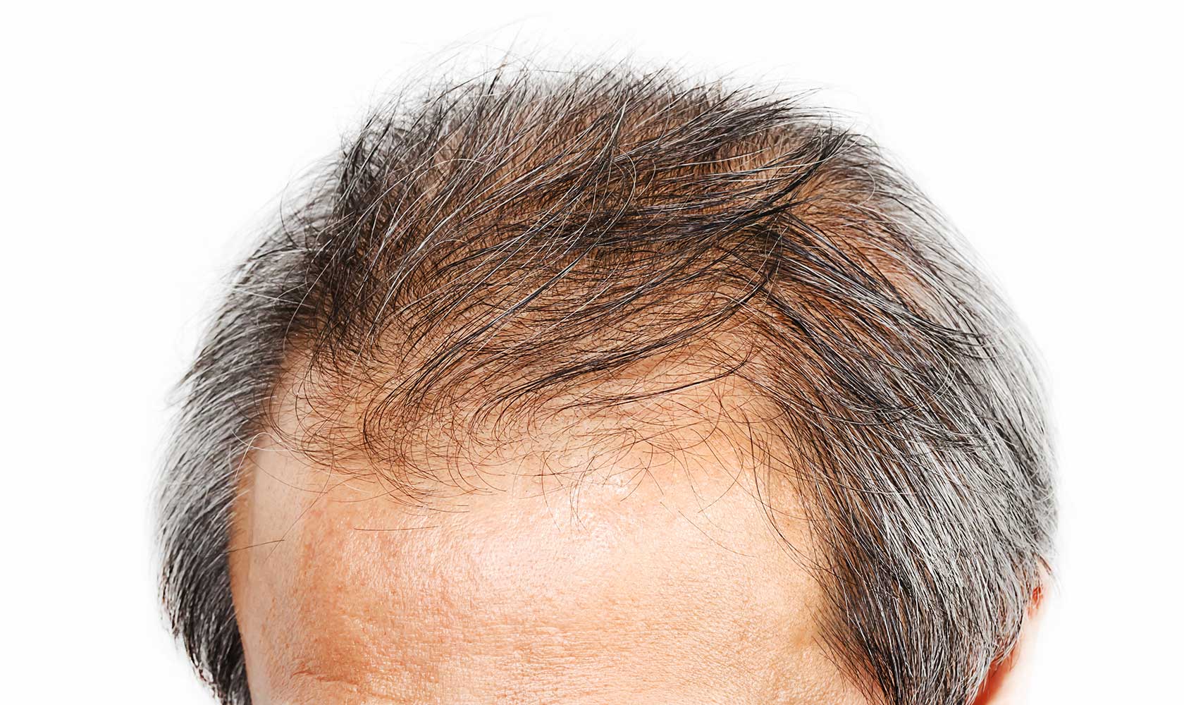 Female Hair Loss Treatment - Shapiro MD
